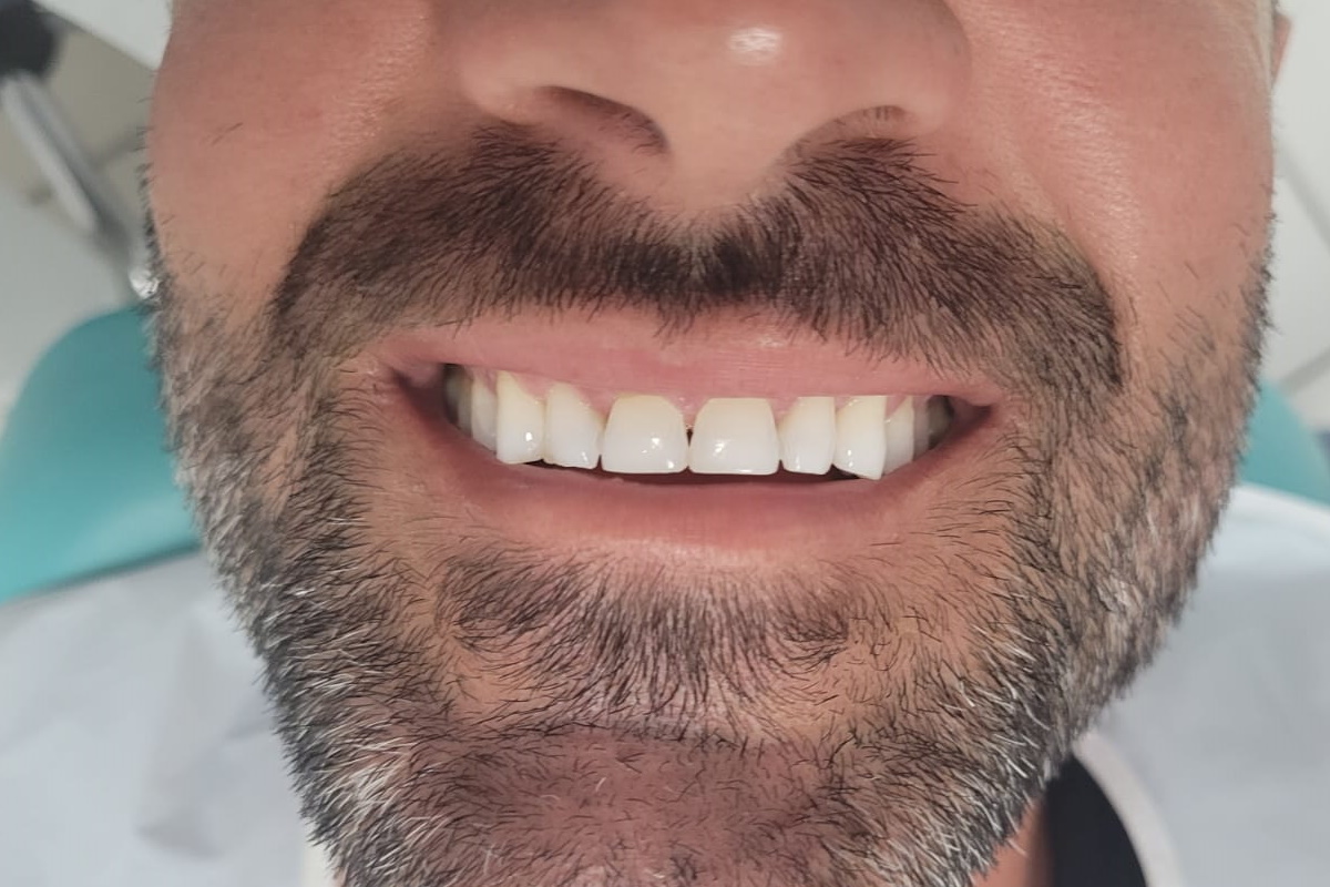 Antes 1